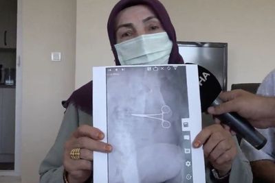 Ngeri, Ada Gunting Tertinggal di Perut Wanita Ini Setelah Operasi Pengencangan Perut