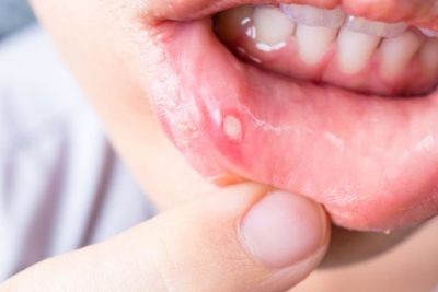 3 Obat Sariawan Paling Ampuh dari Bahan Alami, Salah Satunya Yoghurt