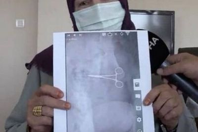 Mengerikan, Gunting Bedah Tertinggal di Dalam Perut Wanita Ini Usai Operasi Angkat Kulit
