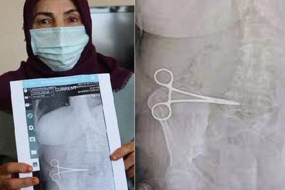 Wanita Ini Merasa Sakit di Perut, Rupanya Dokter Tak Sengaja Tinggalkan Gunting Bedah