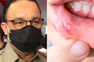 POPULER: Anies Minta Warga Berhenti Merokok karena Covid-19 & Cara Menyembuhkan Sariawan
