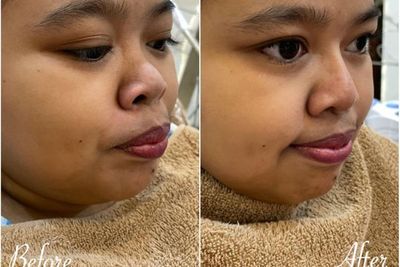 Jalani Filler Hidung, Penampilan Baru Kekeyi Bikin Heboh Netizen