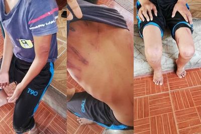 Keji! Bocah 10 Tahun Memar-memar Usai Diduga Menerima Banyak Penyiksaan dari Kakak Iparnya