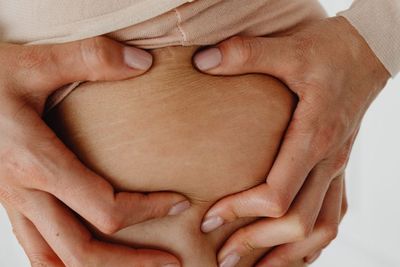 7 Cara Menghilangkan Stretch Mark secara Alami dan Medis, Ampuh!