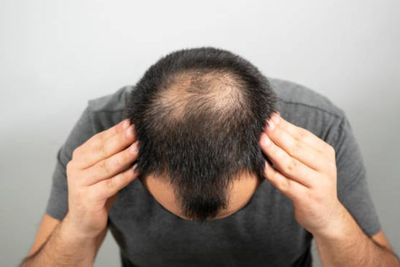 Cara Menumbuhkan Rambut Botak dan Rontok dengan Cepat