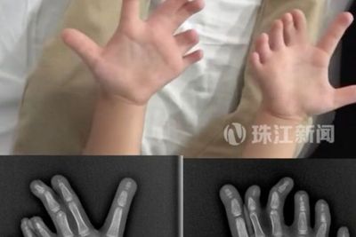 Gadis 4 Tahun yang Memiliki 14 Jari Tangan dan 13 Jari Kaki Berhasil Menjalani Operasi