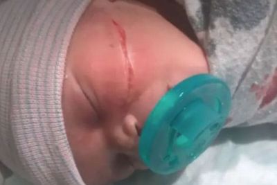 Kasihan, Bayi Perempuan Ini Alami Luka di Wajahnya karena Operasi Caesar Gagal