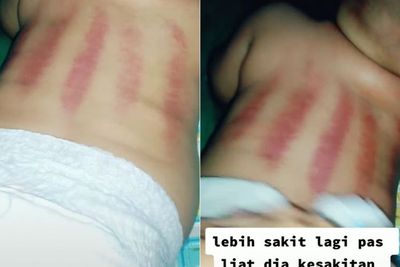 Viral Bayi Sakit Pungungnya Malah Dikerok Sampai Merah, Alasan Ibunya Takut Covid-19
