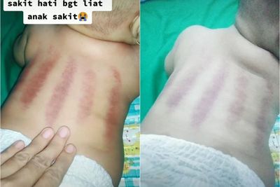 Sedih! Wanita Ini Curhat Tak Tega Lihat Bayinya Kesakitan Dikerok, Netizen Salahkan Ibunya