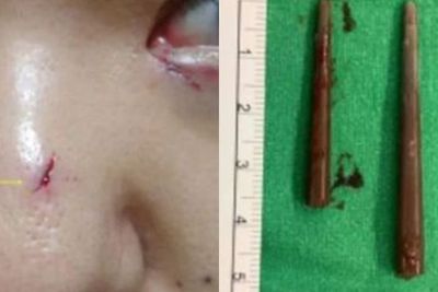 Wanita Ini Menjalani Operasi Usai Mengetahui 2 Pecahan Sumpit Bersarang di Sinusnya