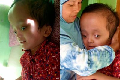 Mari Selamatkan Denda Setiawan, Calon Haafizh yang Mengidap Penyakit Hidrosefalus