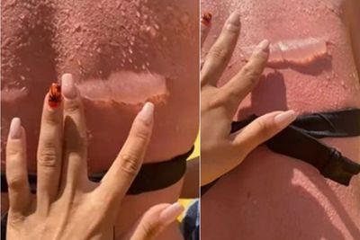 Ngeri, Tubuh Wanita Ini Melepuh karena Tak Pakai Tabir Surya saat Berjemur di Pantai