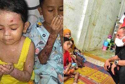 Setelah Viral, Bocah Penderita Penyakit Kulit Ini Dapat Pengobatan Gratis dari Gubernur