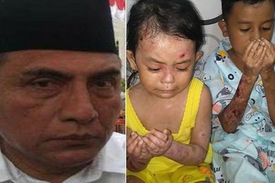 Bocah Haykal dan Zakira Sakit Kulit Langka, Gubernur Edy Curiga Karena Limbah Tambang Emas