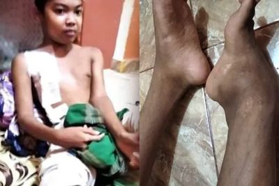 Kevin Butuh Bantuan, Anak Yatim yang Berjuang Melawan Gagal Ginjal dan Tumor Tulang