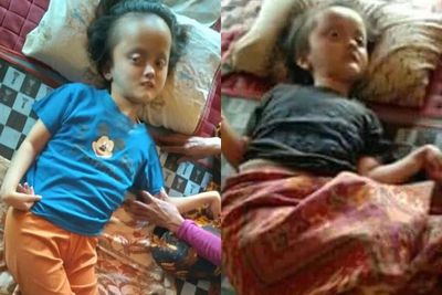 10 Tahun Tak Berobat, Sulastri Terus Berjuang Melawan Hidrosefalus dan Kejang-kejang