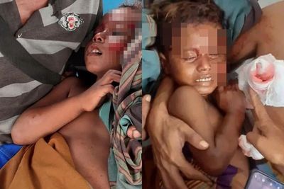 Astagfirullah! Tangan Balita Ini Putus Akibat Diserang Komodo, Tubuhnya Luka Parah