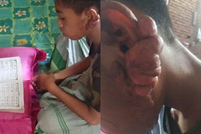 Yatim Piatu, Bocah 12 Tahun Ini Tak Punya Biaya untuk Mengobati Luka Bakarnya