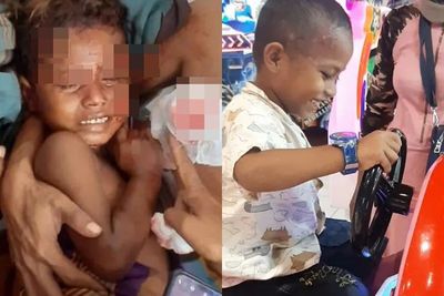Tangan Balita yang Diserang Komodo Kini Telah Dioperasi, Kini Bisa Tersenyum Kembali