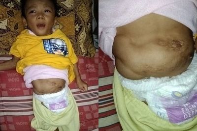 Kasihan! Meski Sudah 3 Kali Operasi Hernia, Perut Balita Ini Masih Tetap Membesar