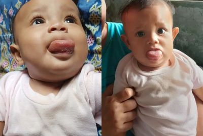 Akibat Mengidap Limfangioma, Lidah Lovila Membesar dan Buat Dirinya Tak Bisa Minum ASI