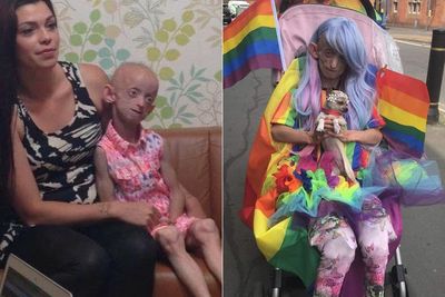 Alami Penyakit Langka, Tubuh Gadis 18 Tahun Bernama Ashanti Ini Menua Lebih Cepat