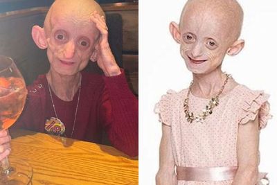 Gadis 18 Tahun Meninggal dengan Tubuh Berusia 144 Tahun karena Penyakit Benjamin Button