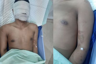 Pemred Media Online di Medan Disiram Air Keras Oleh OTK, Begini Kronologinya