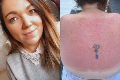 Meski Sudah Pakai Tabir Surya, Wanita Ini Alami Luka Bakar Mengerikan Setelah Berjemur