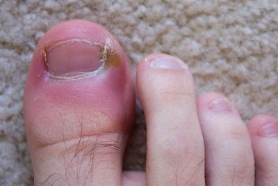 Obat Cantengan Alami yang Ampuh untuk Kuku Kaki dan Tangan