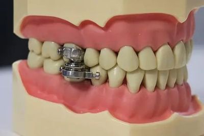 Ilmuwan Ciptakan Alat Penurun Berat Badan, Terbuat dari Magnet