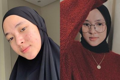 Nissa Sabyan Dapat Perhatian Netizen Karena Wajah Berjerawat: Kalau Hamil Emang Begitu..