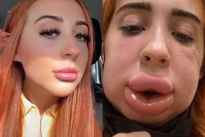 Video Wanita yang Mengalami Reaksi Alergi Setelah Suntik Filler di Bibir