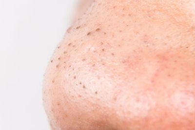Cara Menghilangkan Komedo Hitam (Blackhead) yang Membandel