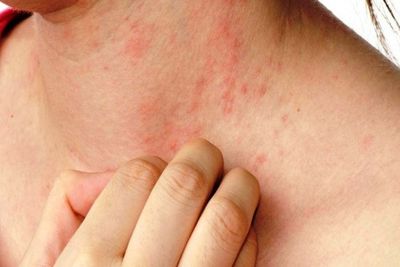 Obat Biang Keringat Alami untuk Anak dan Orang Dewasa