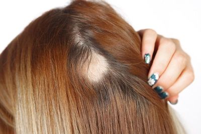 Kerontokan Rambut Picu Kebotakan dan Pitak, Begini Cara Mengatasinya