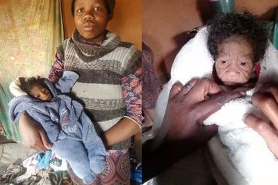 Alami Kondisi Langka, Bayi Ini Lahir dengan Wajah Lebih Tua dari Usianya