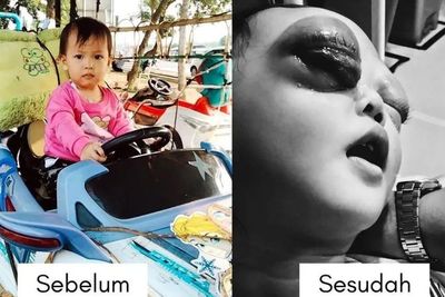 Pilu Bocah Kehilangan Mata Sebelah Kanannya, Berawal dari Benjolan Seperti Digigit Semut