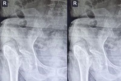 Dokter Unggah Foto Rontgen Patah Panggul, Si Pasien Ngaku Diinjak Setan 10 Tahun Lalu