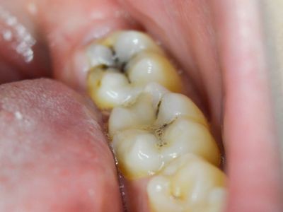 Mengenal Descending Necrotizing Mediastinitis, Penyakit Akibat Gigi Berlubang yang Bisa Merenggut Nyawa
