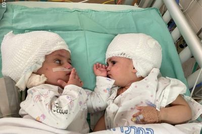 Setelah Menjalankan 12 Jam Operasi, Bayi Kembar Siam Ini Berhasil Dipisahkan