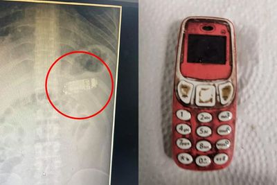 Pria 33 Tahun Ini Ngeluh Sakit Perut, Setelah Dicek Ternyata Ada Ponsel di Dalam Perutnya!