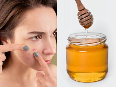 Atasi Jerawat dengan 4 Bahan Alami Ini