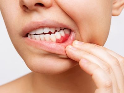 7 Cara Mengempiskan Gusi yang Bengkak dengan Cepat Tanpa Obat