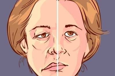 Apa Sih Bell s Palsy Itu? Berikut Ini Penjelasannya