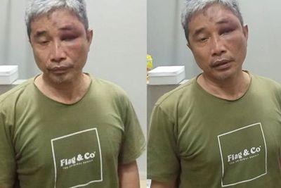 Ini Tampang Muhammad Kece Usai Dihajar Irjen Napoleon, Mata Biru Lebam