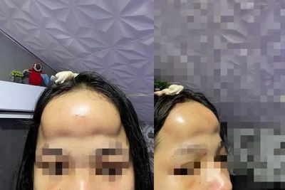 Wanita Ini Oplas Dahi Biar Cantik, Hasilnya Malah Kayak Disengat Lebah