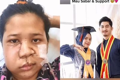 Kisah Wanita yang Punya Sakit di Wajah, Pacar Tetap Setia & Temani Hingga Operasi