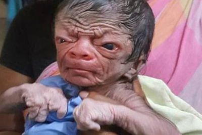 Bayi Ini Terlahir dengan Sindrom Progreria, Punya Wajah seperti Usia 80 Tahun