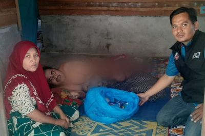 Sedih! Pria di Sumbar Ini Mengidap Diabetes Basah, Jari-jarinya Melepuh Hingga Putus